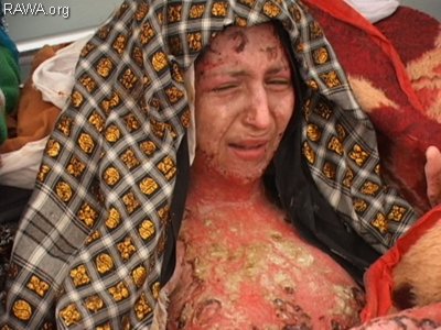گلبر  زنی که بوسیله شوهرش سوزانده شد